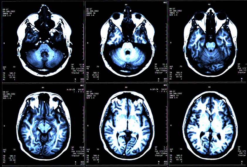 Neurosurgery | East of England